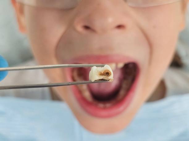 Best Teeth Whitening  in Milton, WA
